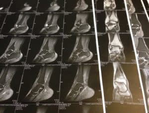 tibialis posterior tendinitis